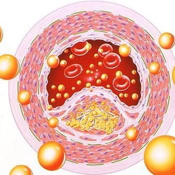 Clear Clogged Arteries (Atherosclerosis) Using This Great Natural Remedy